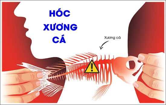 Cách chữa hóc xương cá hiệu quả an toàn