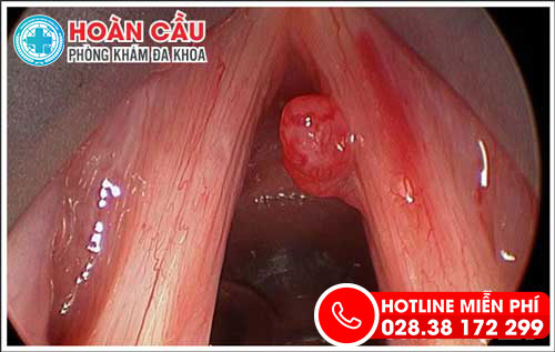 Địa chỉ chữa polyp thanh quản tốt nhất