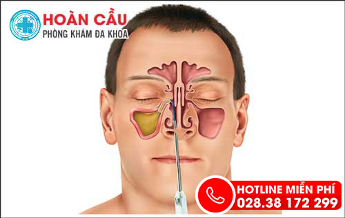 Điều trị viêm xoang như thế nào là hiệu quả?