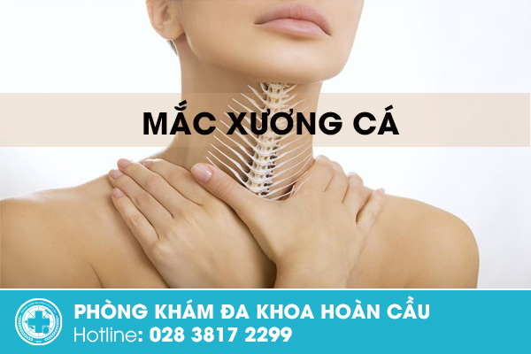 Mắc xương cá xử lý như thế nào đúng cách?