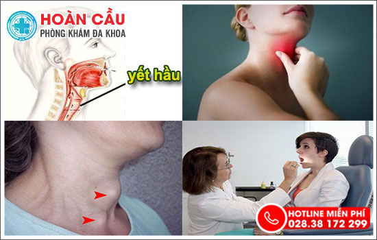 Sưng đau yết hầu là triệu chứng căn bệnh gì?